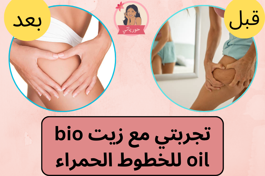 تجربتي مع زيت bio oil للخطوط الحمراء