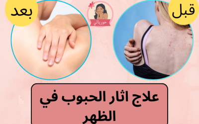 علاج اثار الحبوب في الظهر