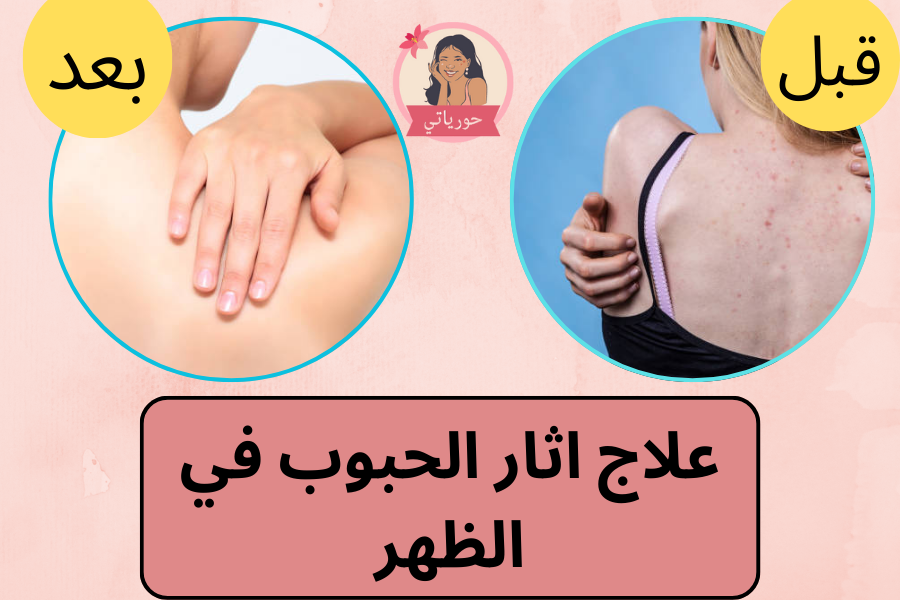 علاج اثار الحبوب في الظهر