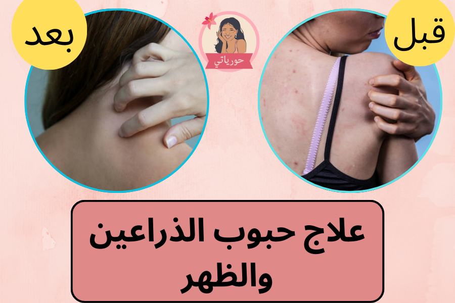 علاج حبوب الذراعين والظهر